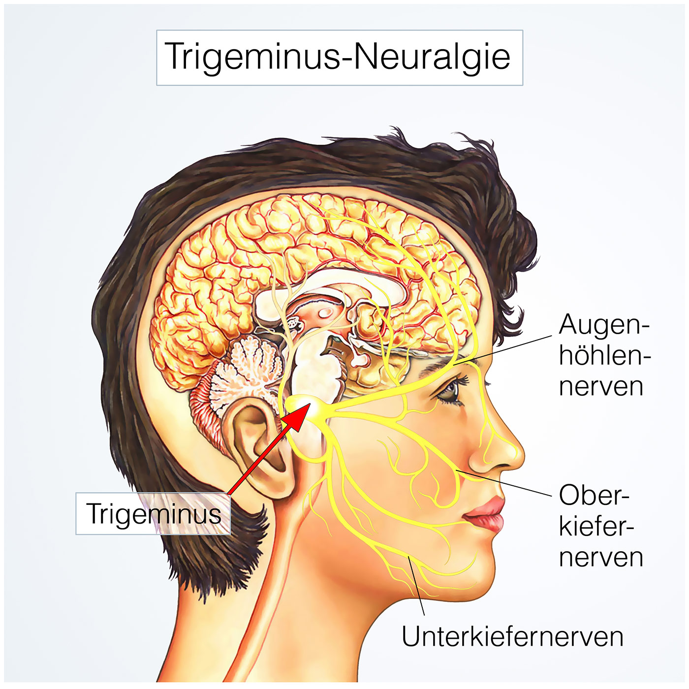 Schmerzarten -- Trigeminusneuralgie